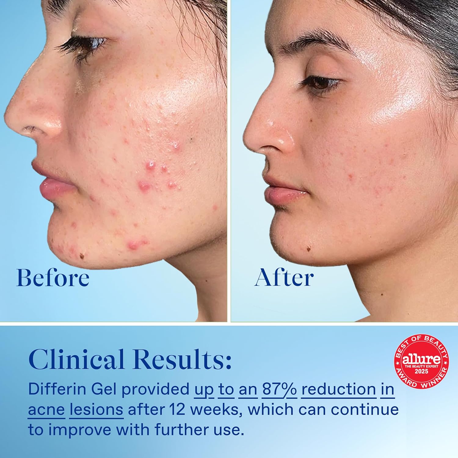 Differin Acne Treatment Gel, 90 Day Supply, Retinoid Treatment for Face with 0.1% Adapalene, Gentle Skin Care for Acne Prone Sensitive Skin, 45g Pump (Packaging May Vary) - Image 6