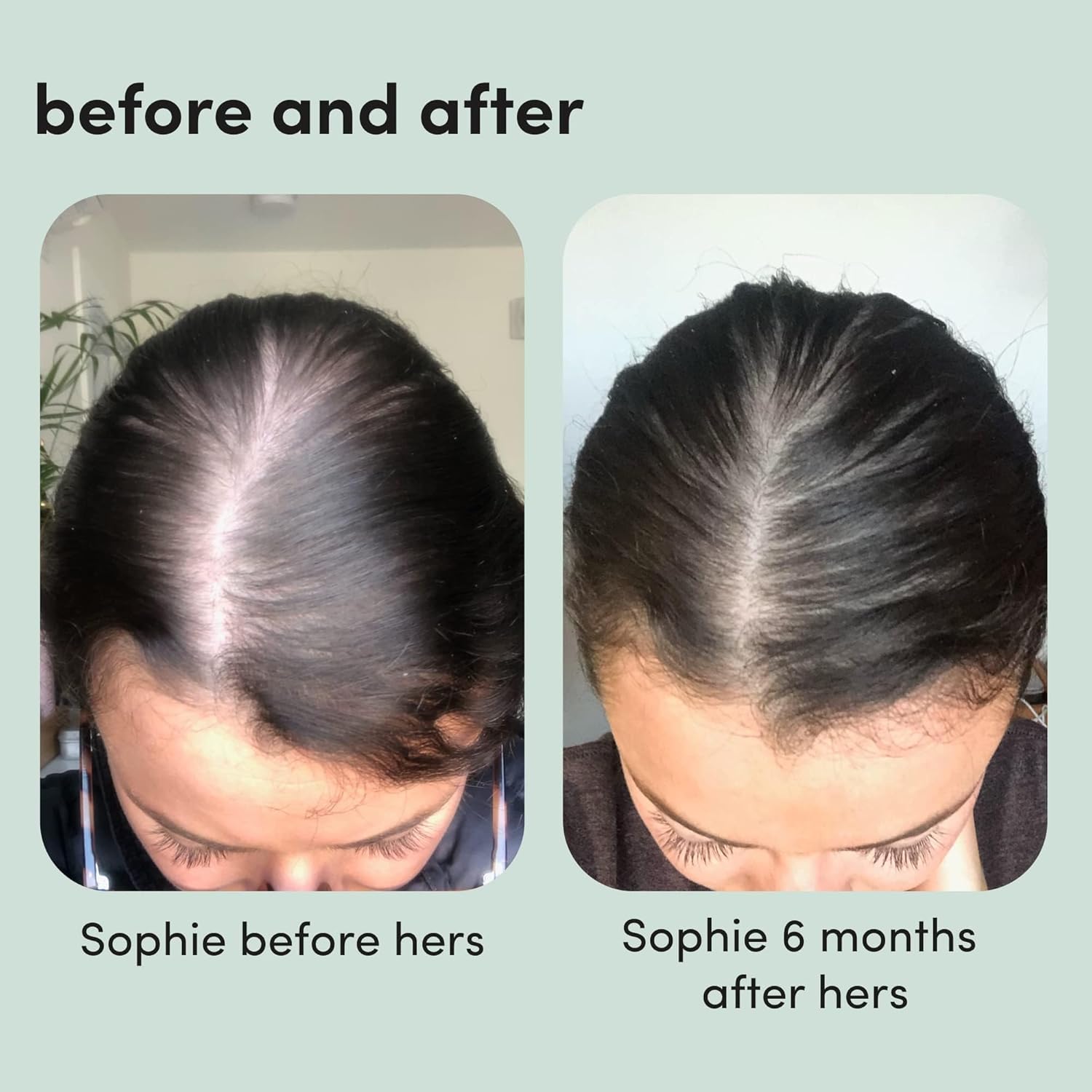 hers Hair Regrowth Treatment - Topical Minoxidil 5% Foam for Women - Extra Strength - Supports Thicker, Fuller Hair - Non-Greasy - Unscented, 2 Pack - Image 6