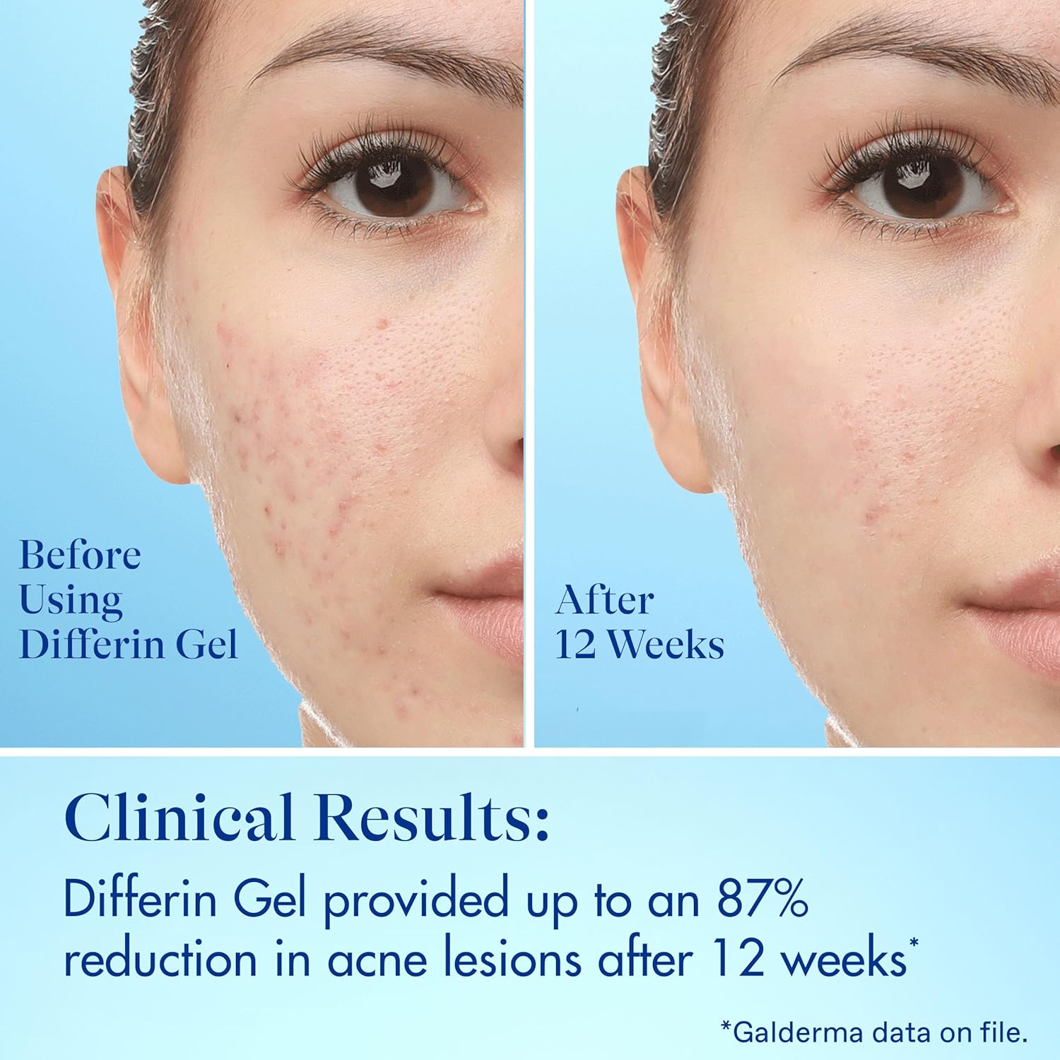 Differin Acne Fighter Pack, Differin Gel Retinoid Acne Treatment For Face with 0.1% Adapalene, 15g Tube + Salicylic Acid Pimple Patches, 36 Count, Designed for Pimple and Acne-Prone Skin - Image 8
