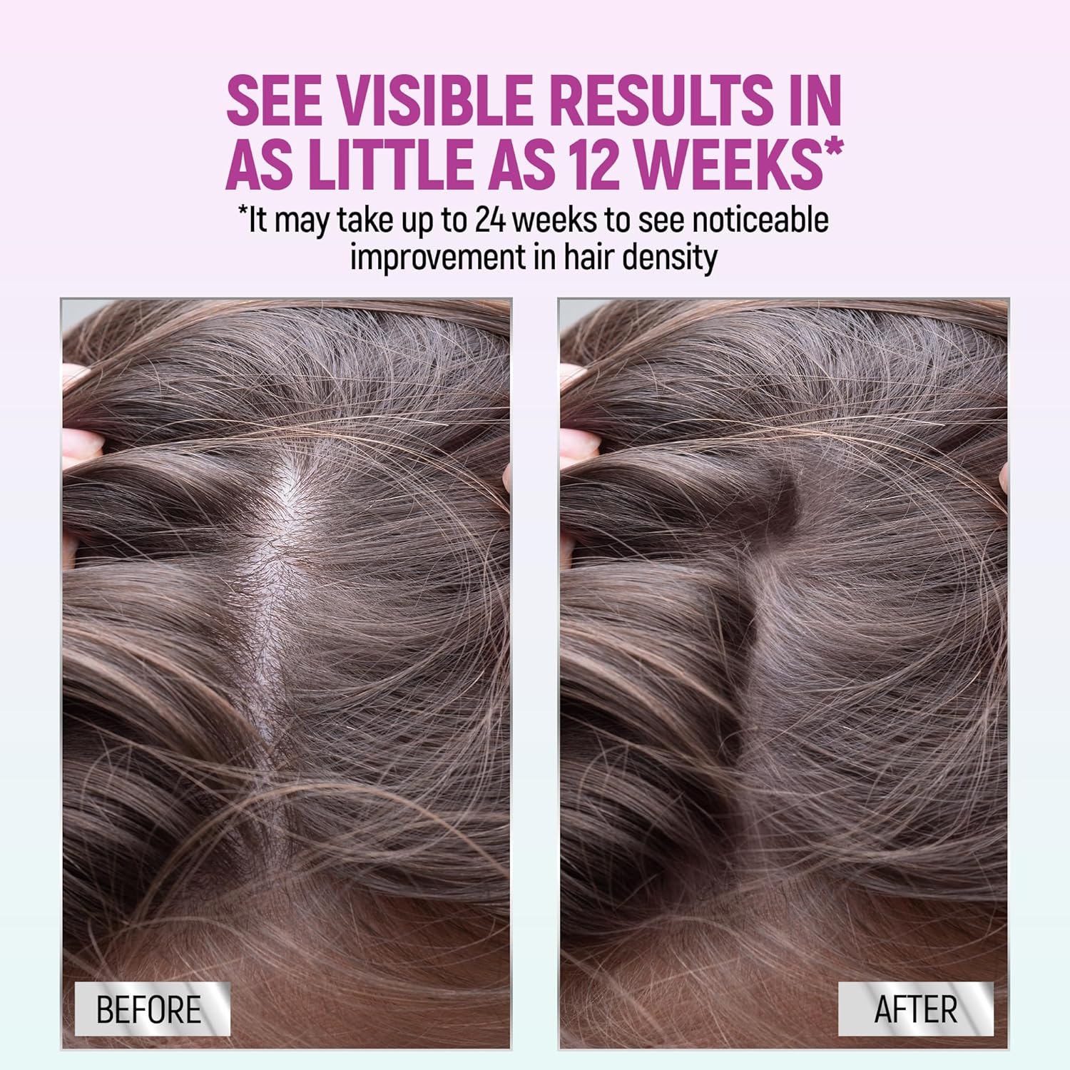 Minoxidil for Women, 2.11 Oz (2 Months Supply) Clinically Proven to Regrow Hair, Topical Aerosol Foam 5%, Hair Thinning Treatment - Image 5