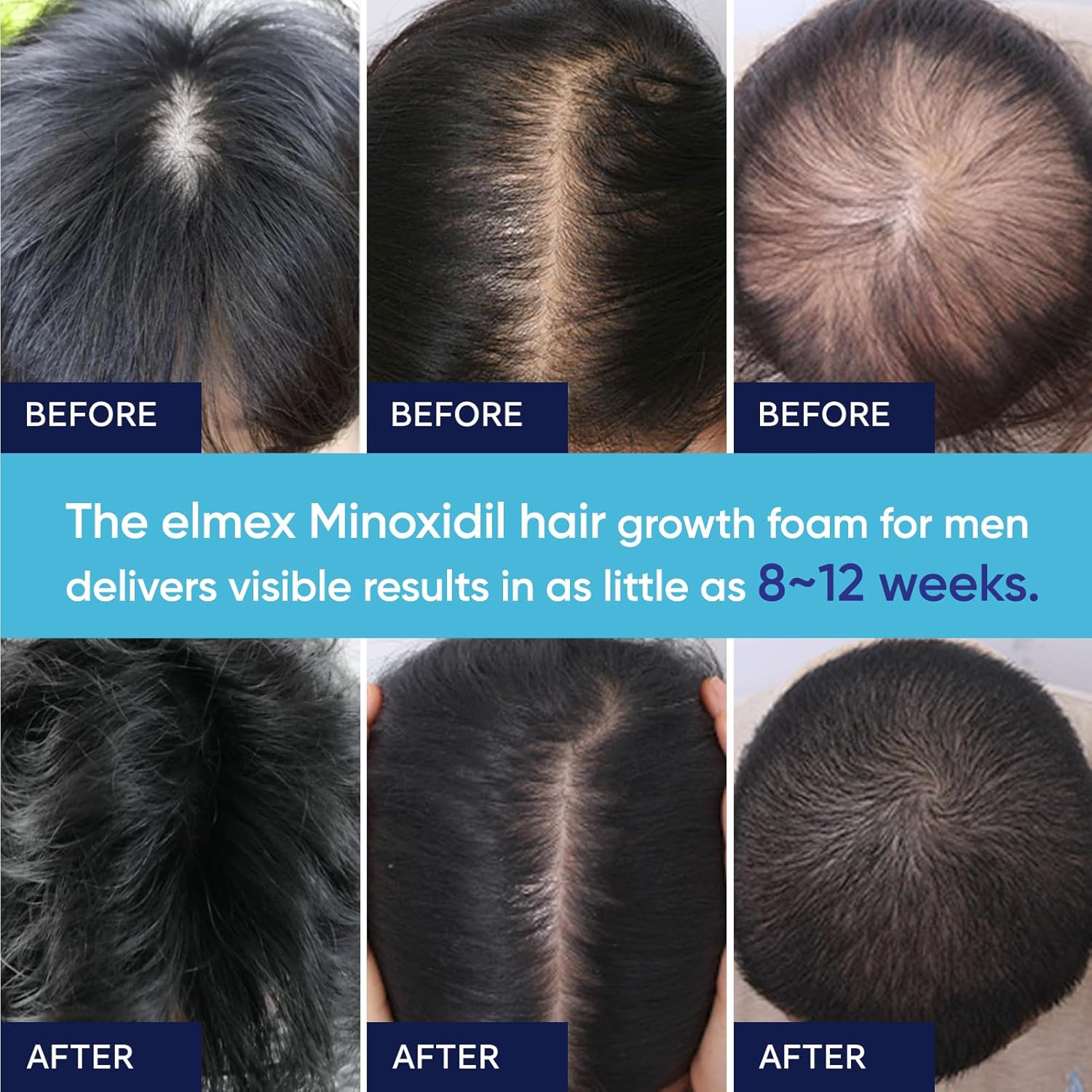 5% Minoxidil Foam for Men, Minoxidil for Men Foam, Minoxidil for Women Hair Growth with Biotin & Castor Oilfor Thicker, Fuller Hair, Fast-Absorbing Formula 180ML-3 Packs - Image 6