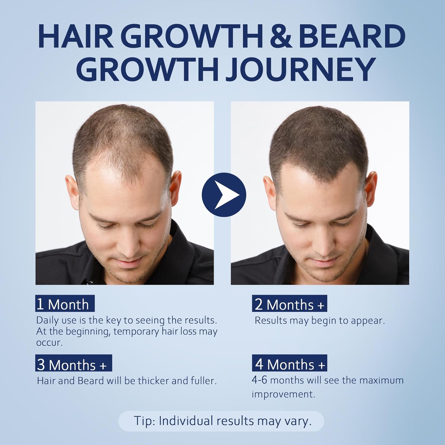 5% Minoxidil Hair Growth Serum for Men & Women with Biotin: Minoxidil for Men and Women, 5 Percent, Hair Regrowth Treatment, Extra Strength (4 FL OZ, Dropper 2pcs) - Image 5