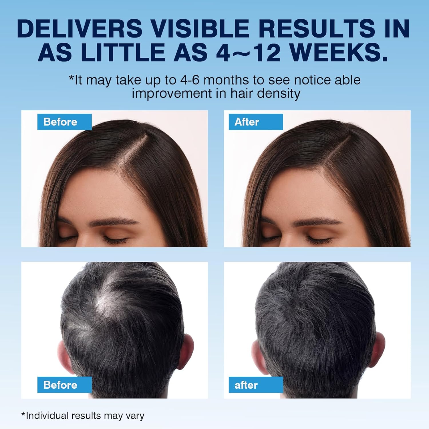 5% Minoxidil Foam– Hair Regrowth Treatment for Men & Women, Prevents Hair Thinning & Strengthens Roots, Minoxidil Foam for Fuller, Healthier Hair,9.52 Ounce (Pack of 1) - Image 4