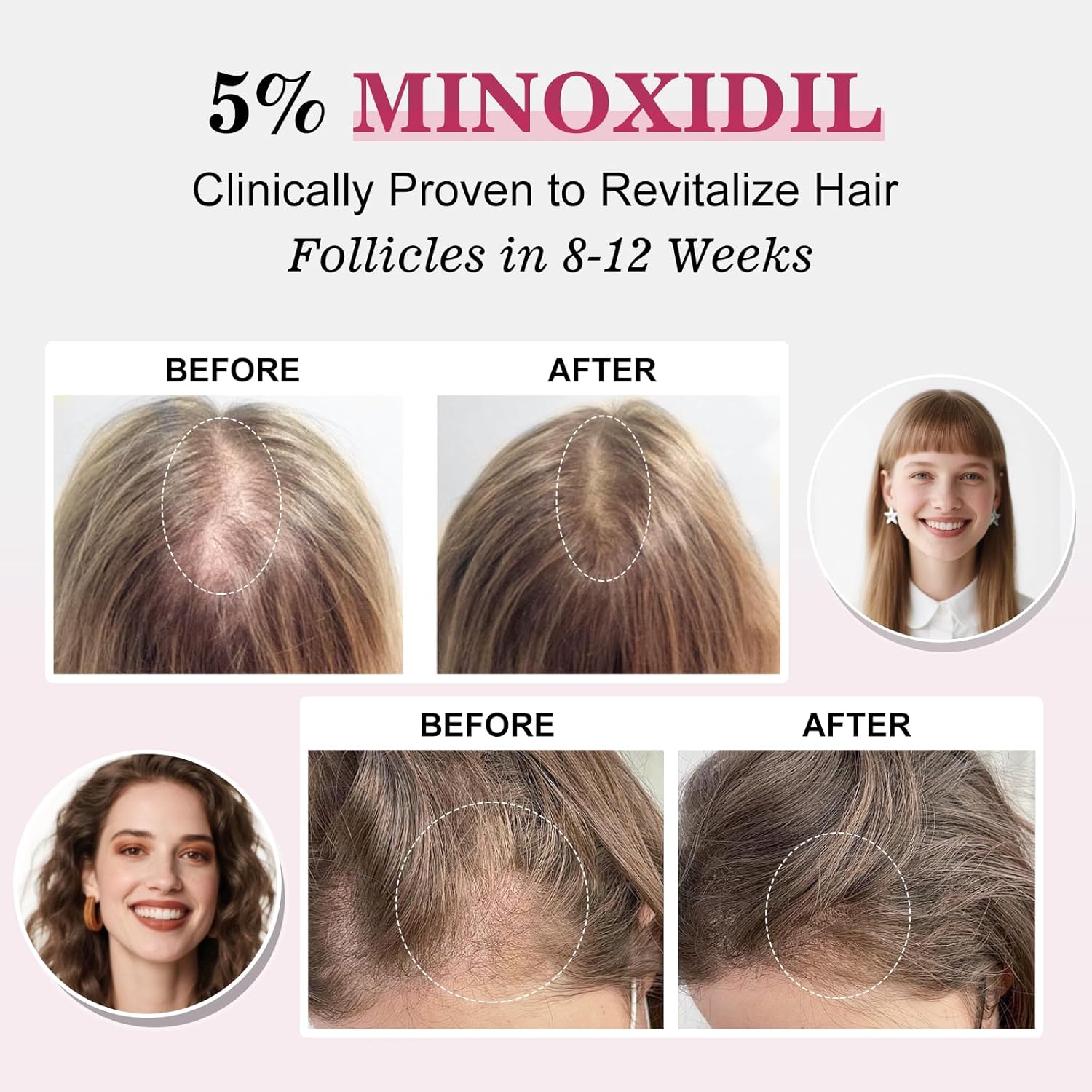 5% Minoxidil for Women Hair Regrowth Spray, hers hair regrowth treatment Infused with Biotin, Extra Strength Treatment to Combat Hair Loss and Thinning, 3 Bottles - Image 3
