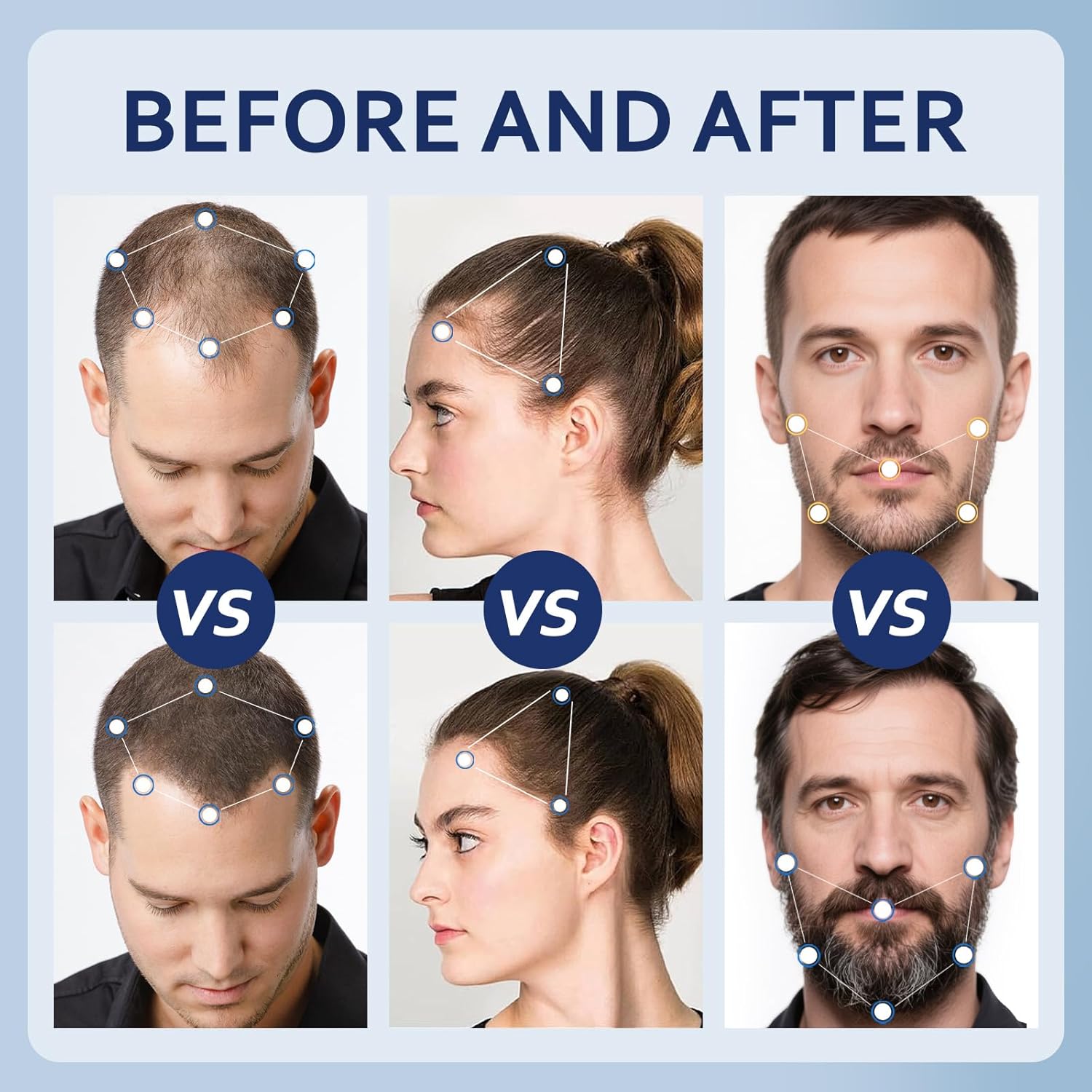 5% Minoxidil Hair Growth Serum for Men & Women with Biotin: Minoxidil for Men and Women, 5 Percent, Hair Regrowth Treatment, Extra Strength (4 FL OZ, Dropper 2pcs) - Image 4