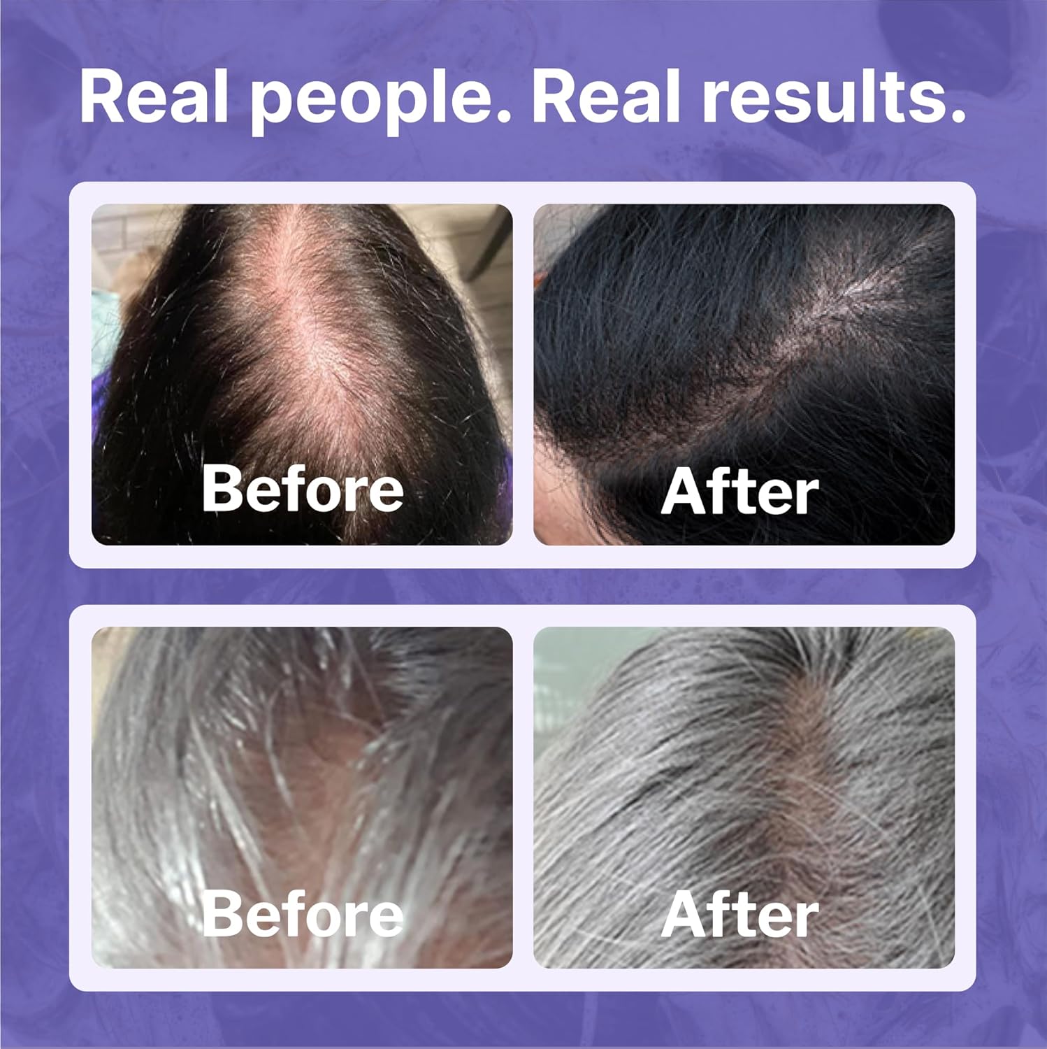 Shapiro MD Hair Growth Experts Women's Regrowth Kit Plus: Shampoo, Conditioner, 2% Minoxidil, Leave-In Foamer. Anti Hair Loss and Thinning Hair Solution for Women, 1 Month - Image 4