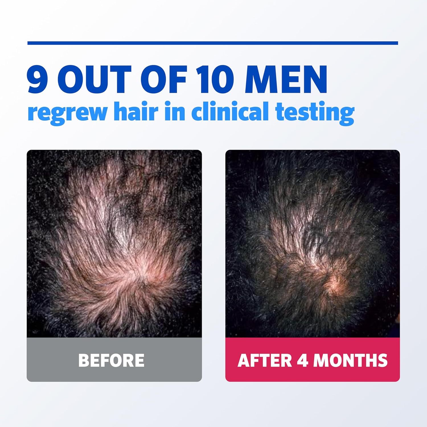 Men’s Rogaine 5% Minoxidil for Men Foam, Clinically Proven Regrowth for Thinning Hair, Topical Hair Loss Treatment, Unscented Topical Aerosol, Results in 8–16 Weeks, 3-Month Supply, 3 x 2.11 oz - Image 4