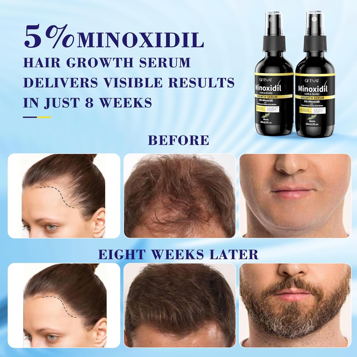 5% Minoxidil Spray for Men and Women Hair Loss Solution with Biotin and Rosemary Hair Growth Serum, Extra Strength 5 Percent Minoxidil for Thicker Fuller Hair Regrowth, 1.96 Fl Oz (Pack of 2) - Image 4