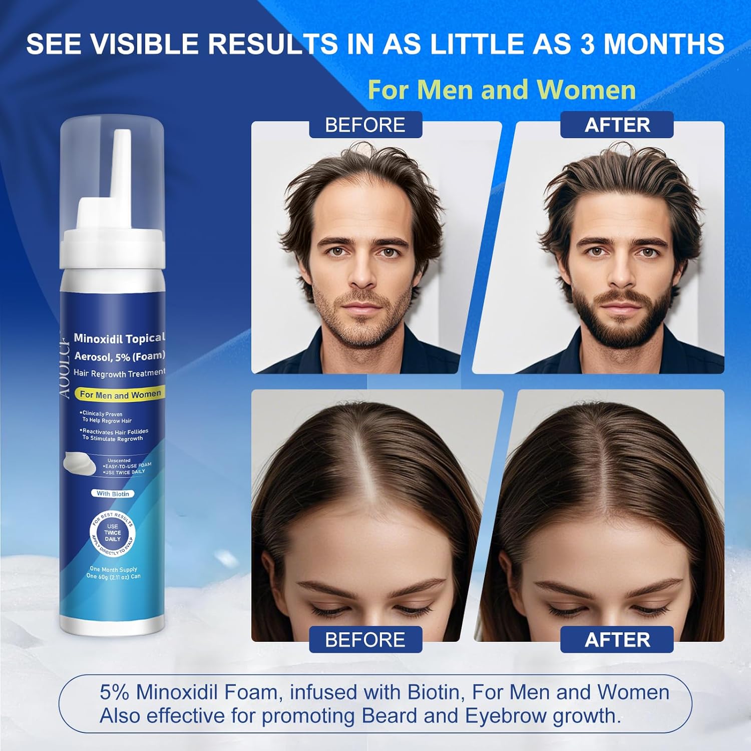 5% Topical Minoxidil Foam, Minoxidil for Men and Women, Infused with Biotin, Hair Growth Treatment, Supports Thicker and Fuller Hair & Beard (Minoxidil Foam, 6.33oz, 3 Month Supply) - Image 4