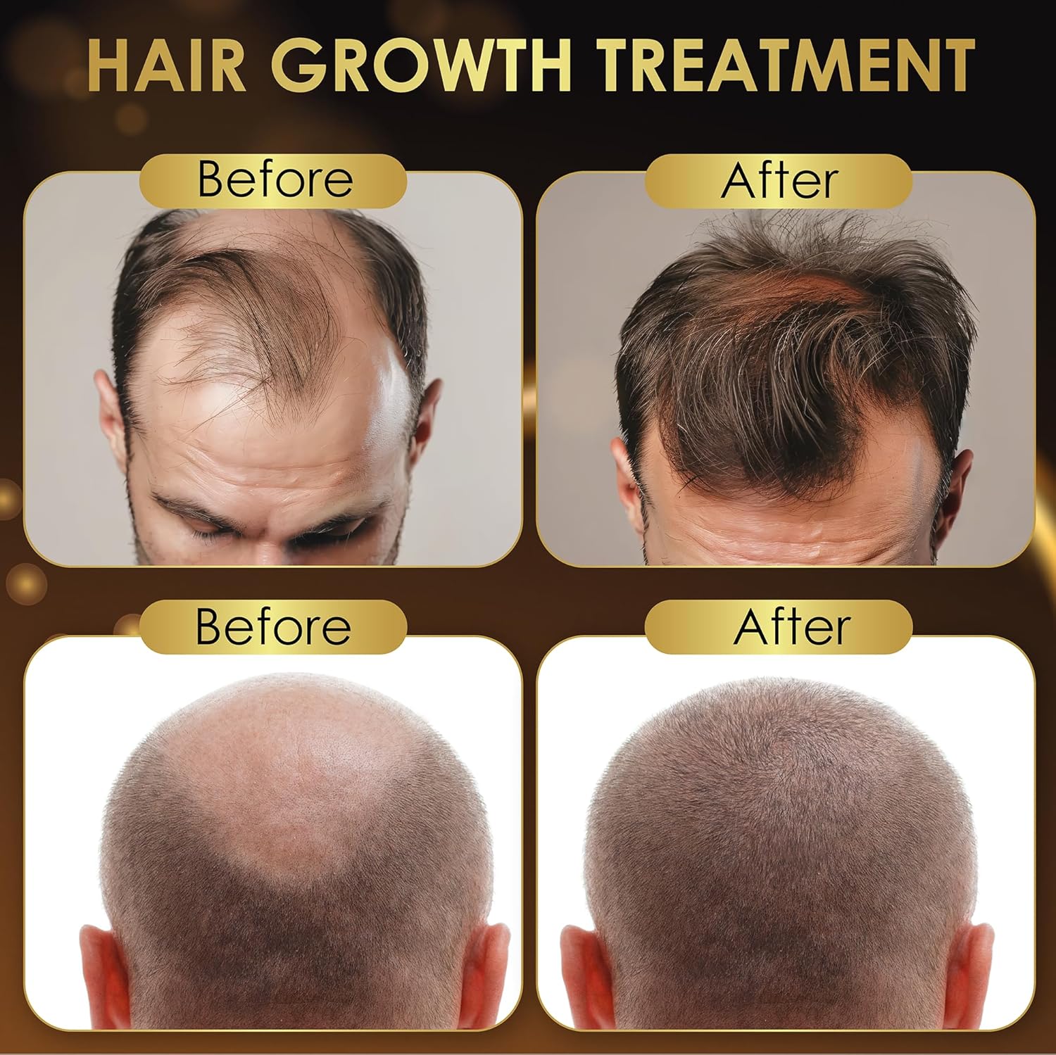 Elevate Hair Regrowth Treatment 5% Minoxidil Solution for Hair Growth - Extra Strength Topical Hair Growth Serum for Thicker, Fuller Hair 2 Fl Oz Made in USA - Image 8